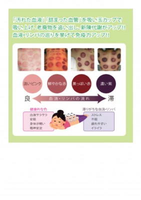 吸い玉療法について（張莉）-4